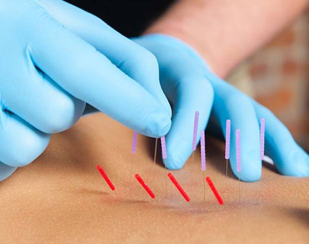 Dry Needling Therapy